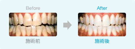 ホワイトニング施術前と施術後の比較